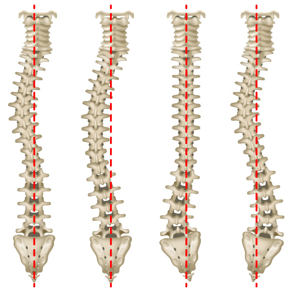Colunas vertebrais humanas com escoliose