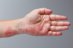 Mão de uma criança com manchas vermelhas causadas pela da doença mão-pé~boca.