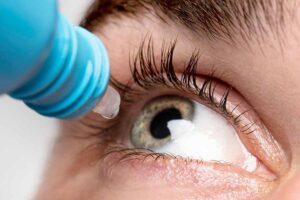 Close de colírio sendo aplicado em um olho. Esse colírio é anestésico. Representação de anestesia nos olhos.