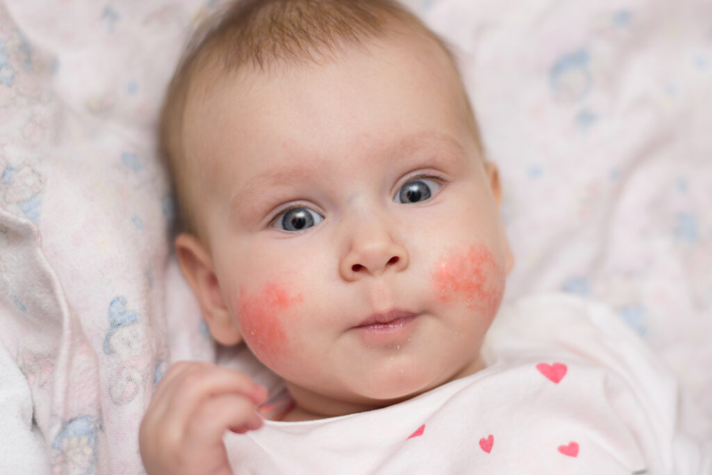 Bebê com manchas vermelhas nas bochechas, características do eritema infeccioso.