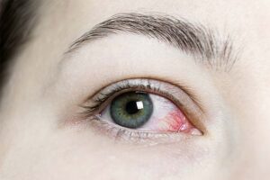 Close de olho de uma mulher com retinopatia hipertensiva. Os vasos sanguíneos do olho estão evidentes.
