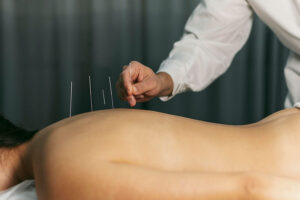 Detalhe de mulher deitada de barriga pra baixo em um cama com médico acupunturista inserindo algumas agulhas nas costas da paciente. Representação da acupuntura.